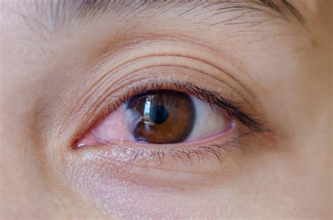carnosidad en los ojos-1